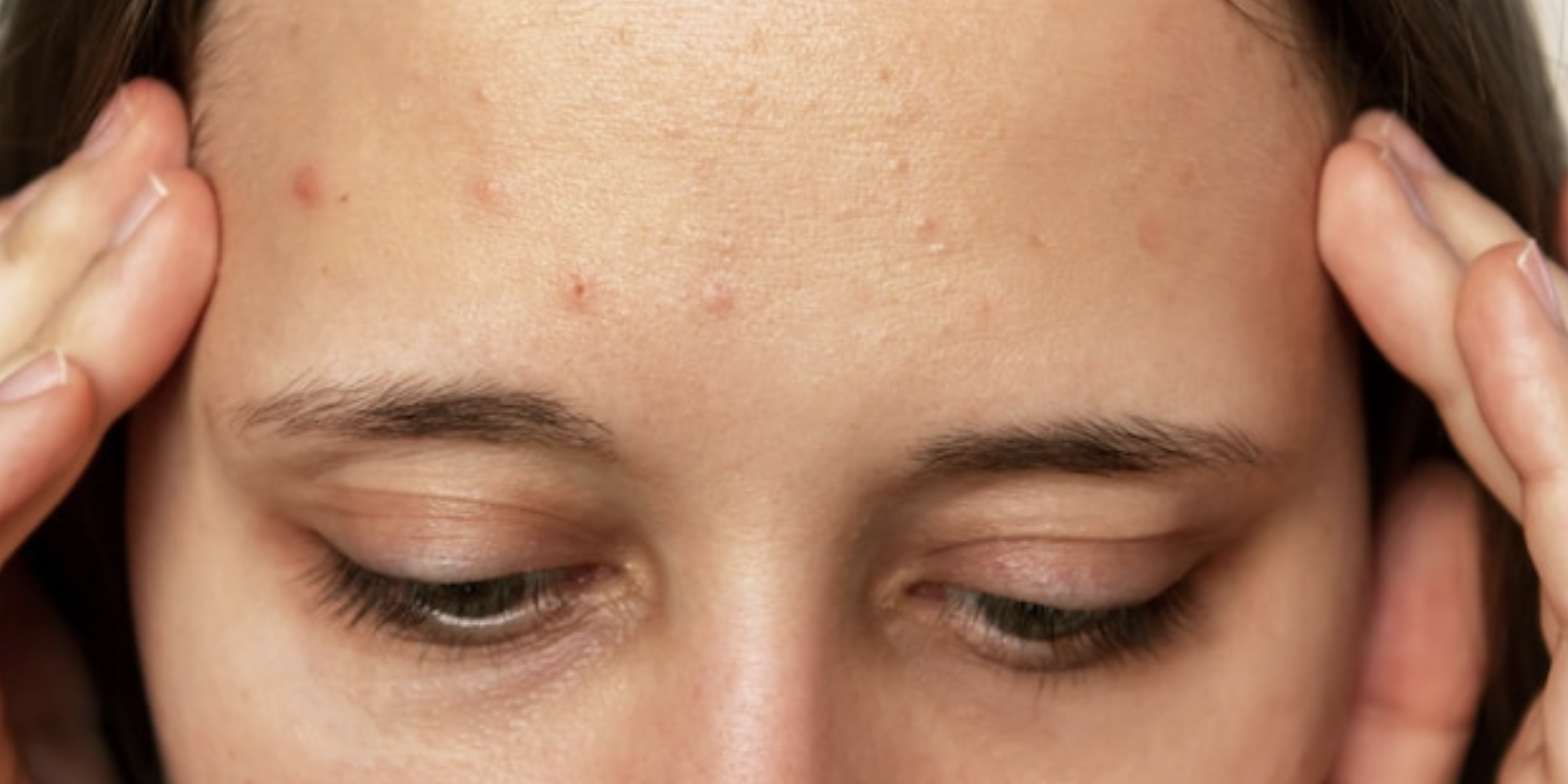 productos para eliminar el acné