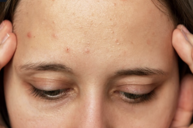 productos para eliminar el acné