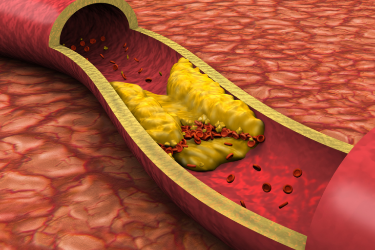 Arteria que transporta colesterol bueno y malo